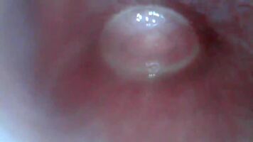 more nonbinary stretched urethra- endoscope view of bladder